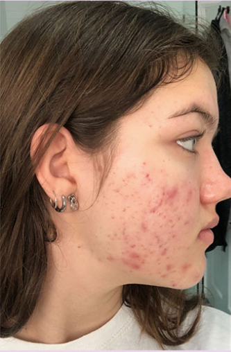 Maddie R. - Before