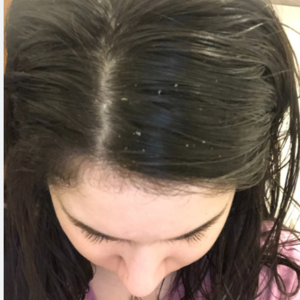 Blair M. - Before